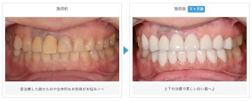 ダイアモンドクラウンの症例写真""